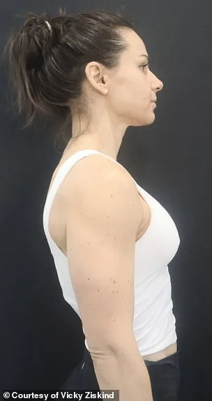 Revolutionizing Breast Augmentation: A Minimally Invasive Breakthrough in Plastic Surgery