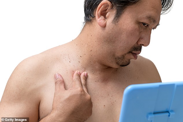 Skin Tags May Signal Insulin Resistance and Hidden Diabetes Risk