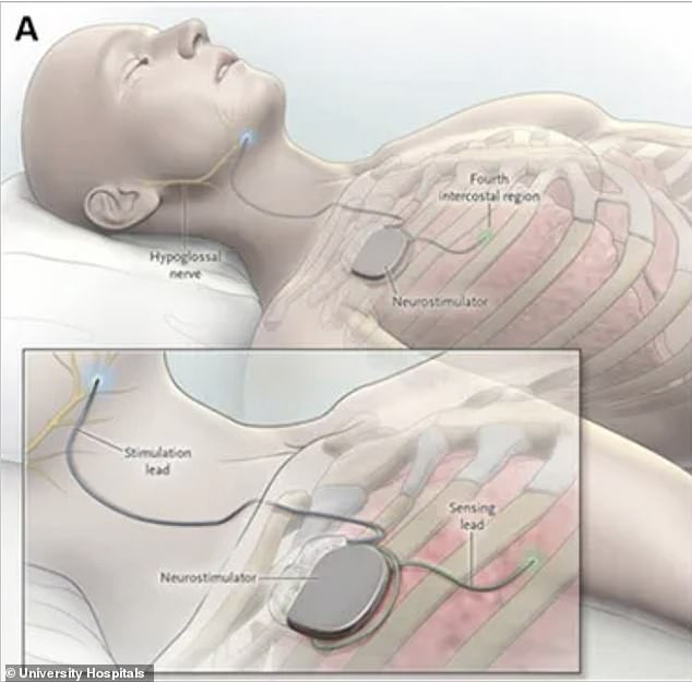 New Implant Eliminates Need for Sleep Apnea Breathing Machines