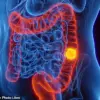 Blood Test Detects Early Signs of Bowel Cancer Through DNA Fragments