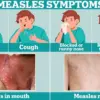 Measles Case in Pennsylvania Raises Outbreak Concerns