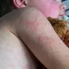 Measles Cases in America Surpass 2023 Totals in Just Two Months
