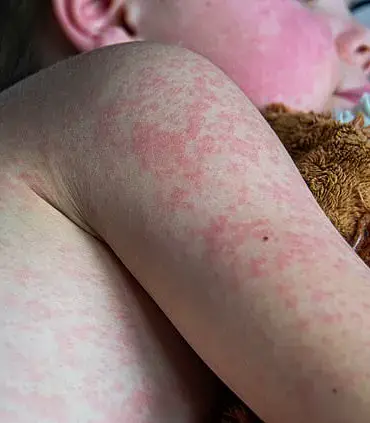 Measles Cases in America Surpass 2023 Totals in Just Two Months