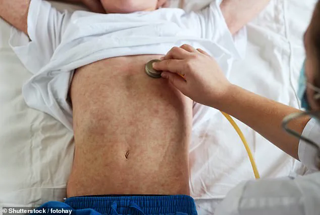Measles Outbreak in the US: Addressing Vaccine Hesitancy for Public Wellbeing
