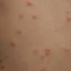 Penn State University Tackles Chickenpox Outbreak: What We Know So Far