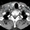 Rare Case: COVID-19 Booster Reactivates Dormant Tuberculosis in Patient