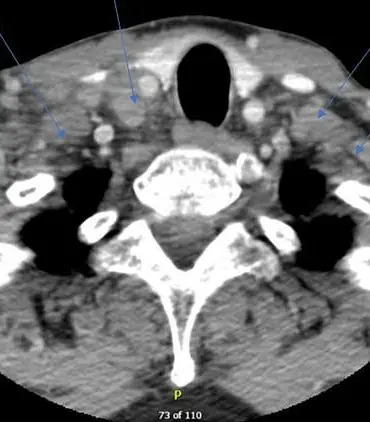 Rare Case: COVID-19 Booster Reactivates Dormant Tuberculosis in Patient