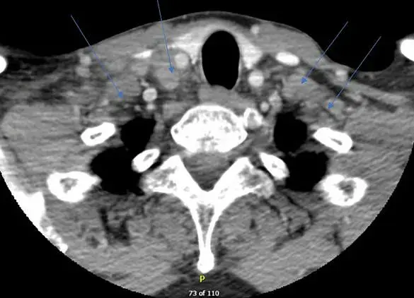 Rare Case: COVID-19 Booster Reactivates Dormant Tuberculosis in Patient