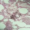 Stone mason falls ill with silicosis due to workplace dust exposure