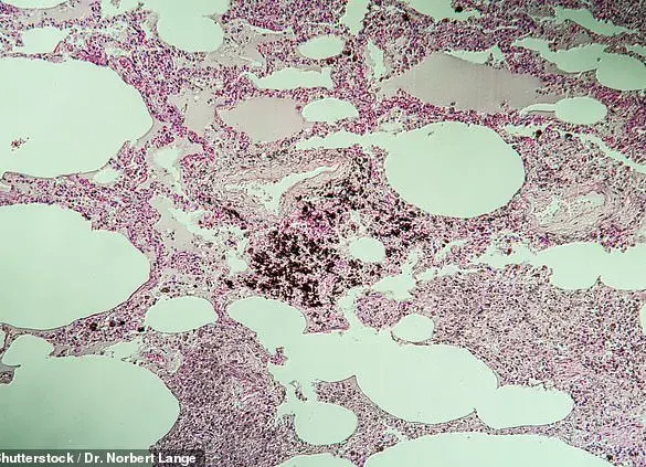 Stone mason falls ill with silicosis due to workplace dust exposure