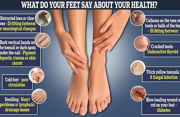 The Irish Pinky Toe: Unraveling a Little-Known Foot Condition