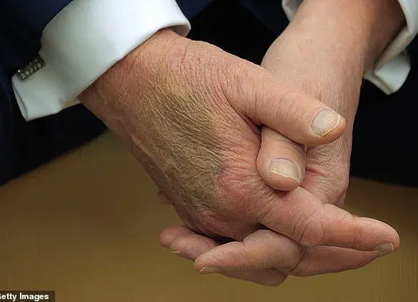 Trump Hand Mark: Medical Expert Explains