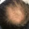 Breakthrough Protein Discovery Offers New Hope for Hair Loss Prevention