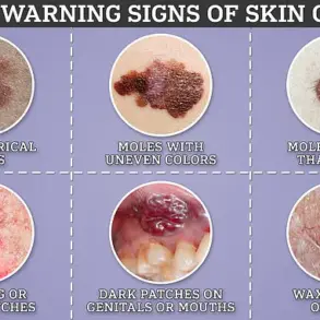 Exclusive NHS Access to Revolutionary Cancer Vaccine for Melanoma Patients
