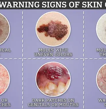 Exclusive NHS Access to Revolutionary Cancer Vaccine for Melanoma Patients