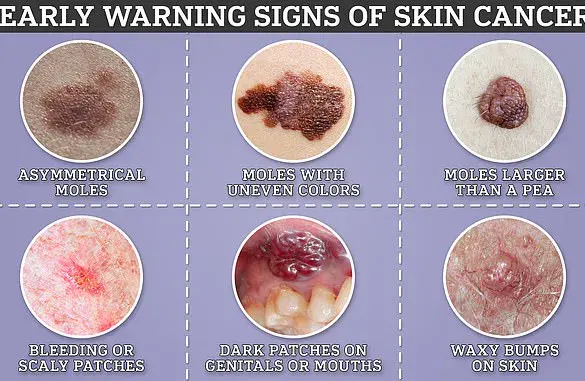 Exclusive NHS Access to Revolutionary Cancer Vaccine for Melanoma Patients
