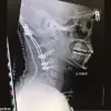 Farmer's Near Miss with 'Internal Decapitation' Spotlights Medical Marvels