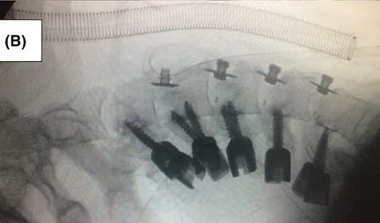 Exclusive Images Reveal Rare Drug-Induced Condition: Dropped Head Syndrome Exposed by Iranian Hospital
