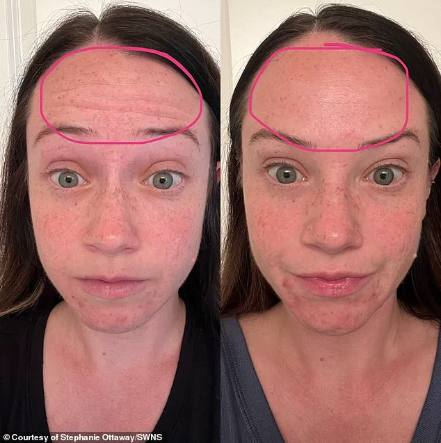 Influencer's Fight for Life After Botox-Like Injections Lead to Rare Botulism Diagnosis
