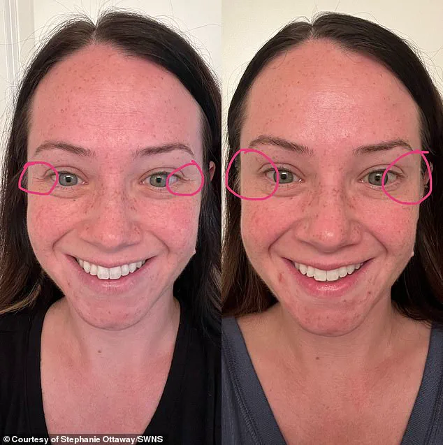 Influencer's Fight for Life After Botox-Like Injections Lead to Rare Botulism Diagnosis