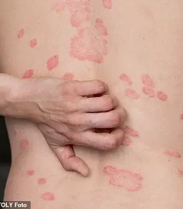 New Research Links Abdominal Fat to Psoriasis, Shifting Focus from General Obesity
