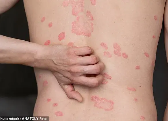 New Research Links Abdominal Fat to Psoriasis, Shifting Focus from General Obesity