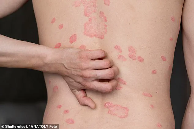 New Research Links Abdominal Fat to Psoriasis, Shifting Focus from General Obesity
