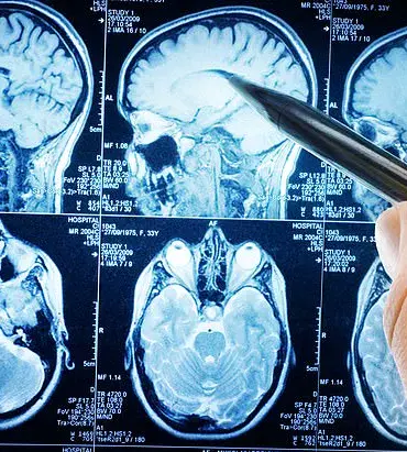 Breakthrough Study Reveals Urgent Link Between Carb Reduction and Alzheimer's Prevention