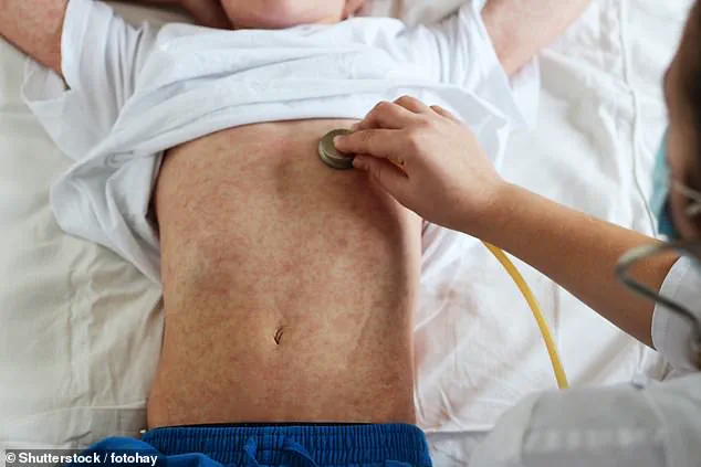 Kensington and Chelsea Faces Low MMR Vaccination Rates, Falling Short of 95% Target: Health Officials Urge Action
