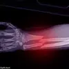 Weight-loss Drugs Linked to Osteoporosis Risk, Study Finds 40% Bone Loss in Patients