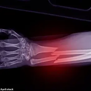 Weight-loss Drugs Linked to Osteoporosis Risk, Study Finds 40% Bone Loss in Patients