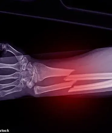 Weight-loss Drugs Linked to Osteoporosis Risk, Study Finds 40% Bone Loss in Patients