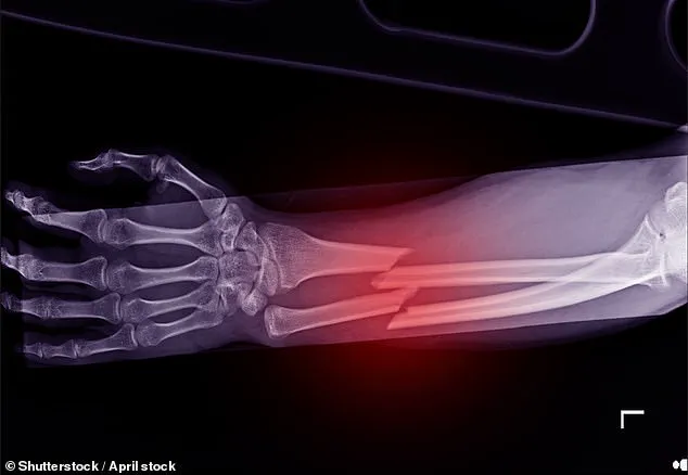 Weight-loss Drugs Linked to Osteoporosis Risk, Study Finds 40% Bone Loss in Patients