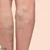 A Star's Secret Struggle: David Tag and His Varicose Vein