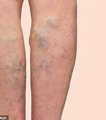 A Star's Secret Struggle: David Tag and His Varicose Vein