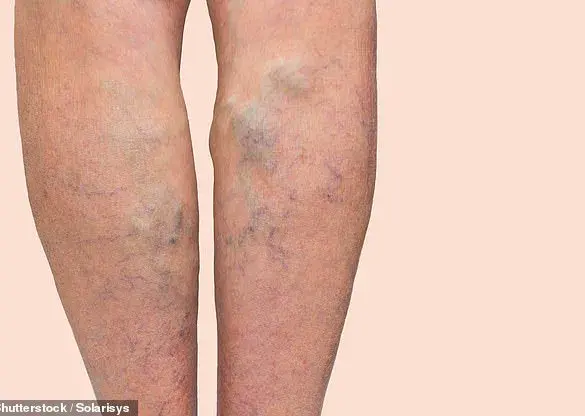 A Star's Secret Struggle: David Tag and His Varicose Vein