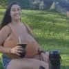 Breaking: Brazilian Woman with Rare Gigantomastia Shares Her Journey as Medical Community Rises to Aid