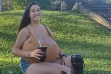 Breaking: Brazilian Woman with Rare Gigantomastia Shares Her Journey as Medical Community Rises to Aid
