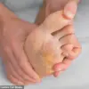Expert Warns: Common Foot Care Mistakes Pose Hidden Health Risks