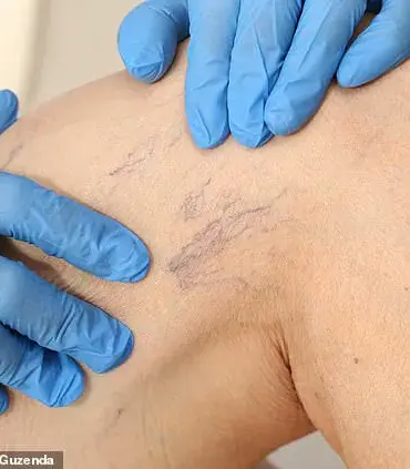 From Cosmetic to Concern: Thread Veins and the Growing Call for Medical Attention, According to Dr. Ellie Cannon