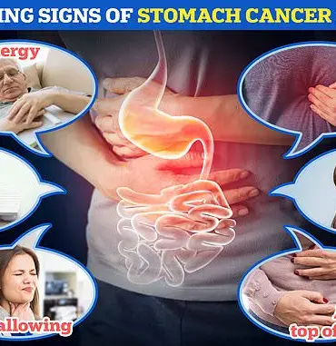 Helicobacter pylori Linked to 76% of Global Stomach Cancer Cases, Warn Scientists of Millions of Lives at Risk