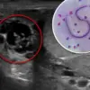 Hidden Threat: Rising Cases of Alpha-Gal Syndrome and Expert Warnings About Tick-Borne Allergies