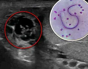 Hidden Threat: Rising Cases of Alpha-Gal Syndrome and Expert Warnings About Tick-Borne Allergies
