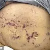 Late-Breaking: Parasitic Infections in Two New England Patients After Kidney Transplants from Same Donor Raise Medical Alarms