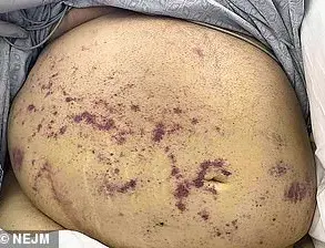 Late-Breaking: Parasitic Infections in Two New England Patients After Kidney Transplants from Same Donor Raise Medical Alarms