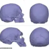 New Study Links Neanderthal Genes to Chiari Malformations, Tying Ancient Heritage to Modern Headache Risks