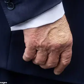 President Trump Diagnosed with Chronic Venous Insufficiency, Prompting Public Health Discussion
