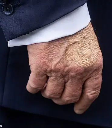 President Trump Diagnosed with Chronic Venous Insufficiency, Prompting Public Health Discussion