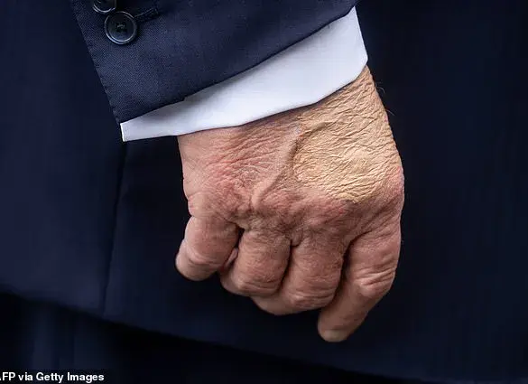 President Trump Diagnosed with Chronic Venous Insufficiency, Prompting Public Health Discussion
