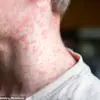 Urgent Warning: Measles Resurgence Looms as MMR Vaccination Rates Plummet Amid Child's Death in Liverpool – Experts Urge Immediate Action
